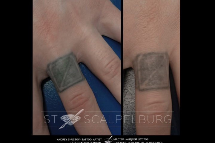 Осветление татуировки при помощи лазера